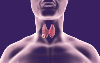 thyroid-cancer