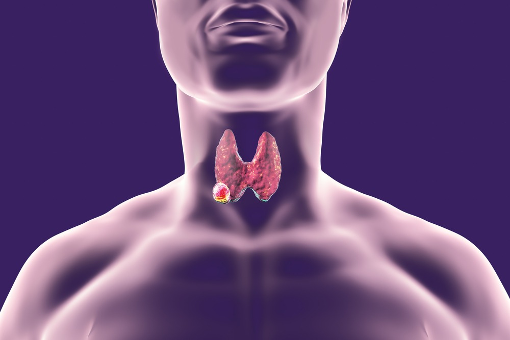 thyroid biopsy la