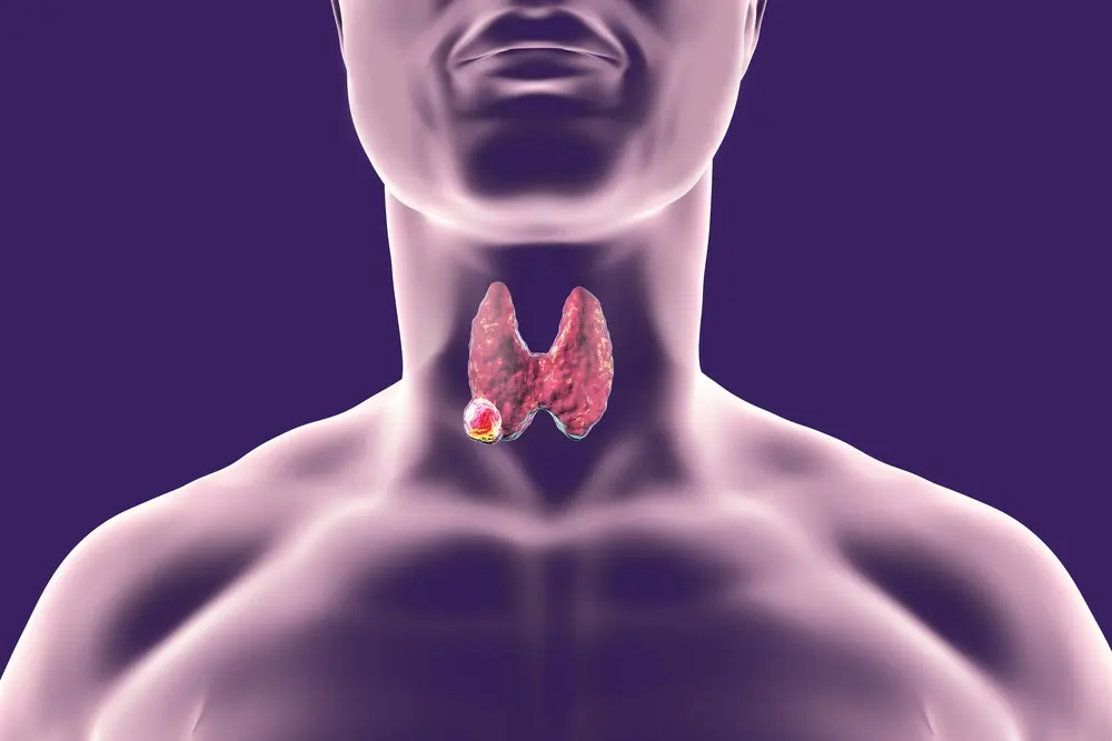 An illustration of a human neck highlighting the thyroid gland, emphasizing the importance of thyroid biopsy for accurate diagnosis and compassionate care in medical treatment.| Dr. Nadelman Biopsy Doctor