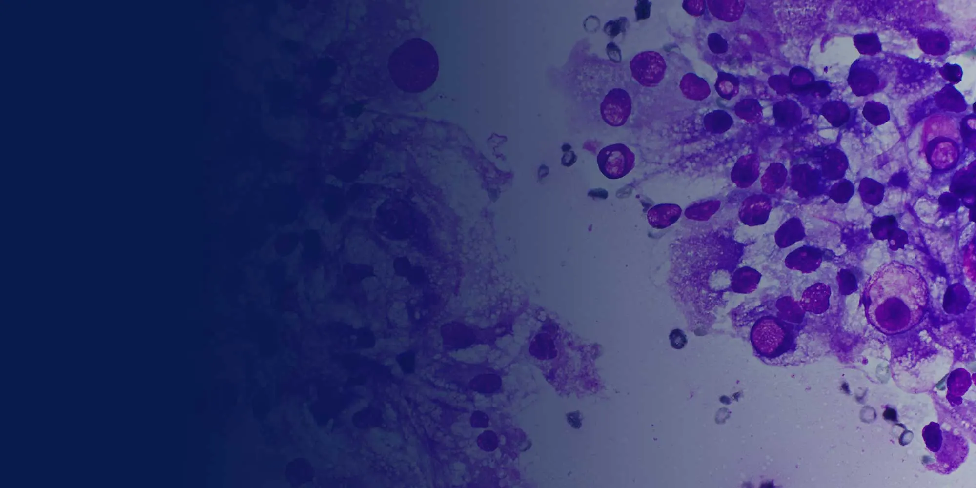 thyroid-cancer thyroid-cancer