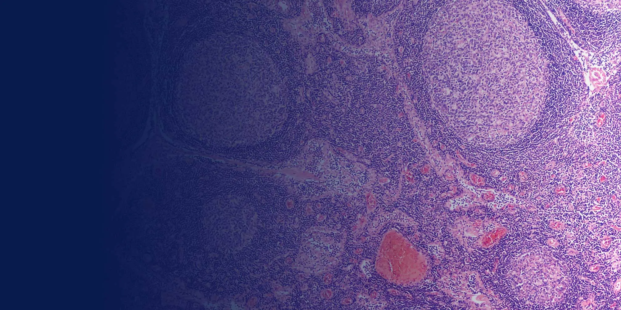 lymph-nodes-hero Cancer Biopsy & FNA Doctor in Los Angeles - Dr. Nadelman
