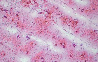 Benign Colloid nodule