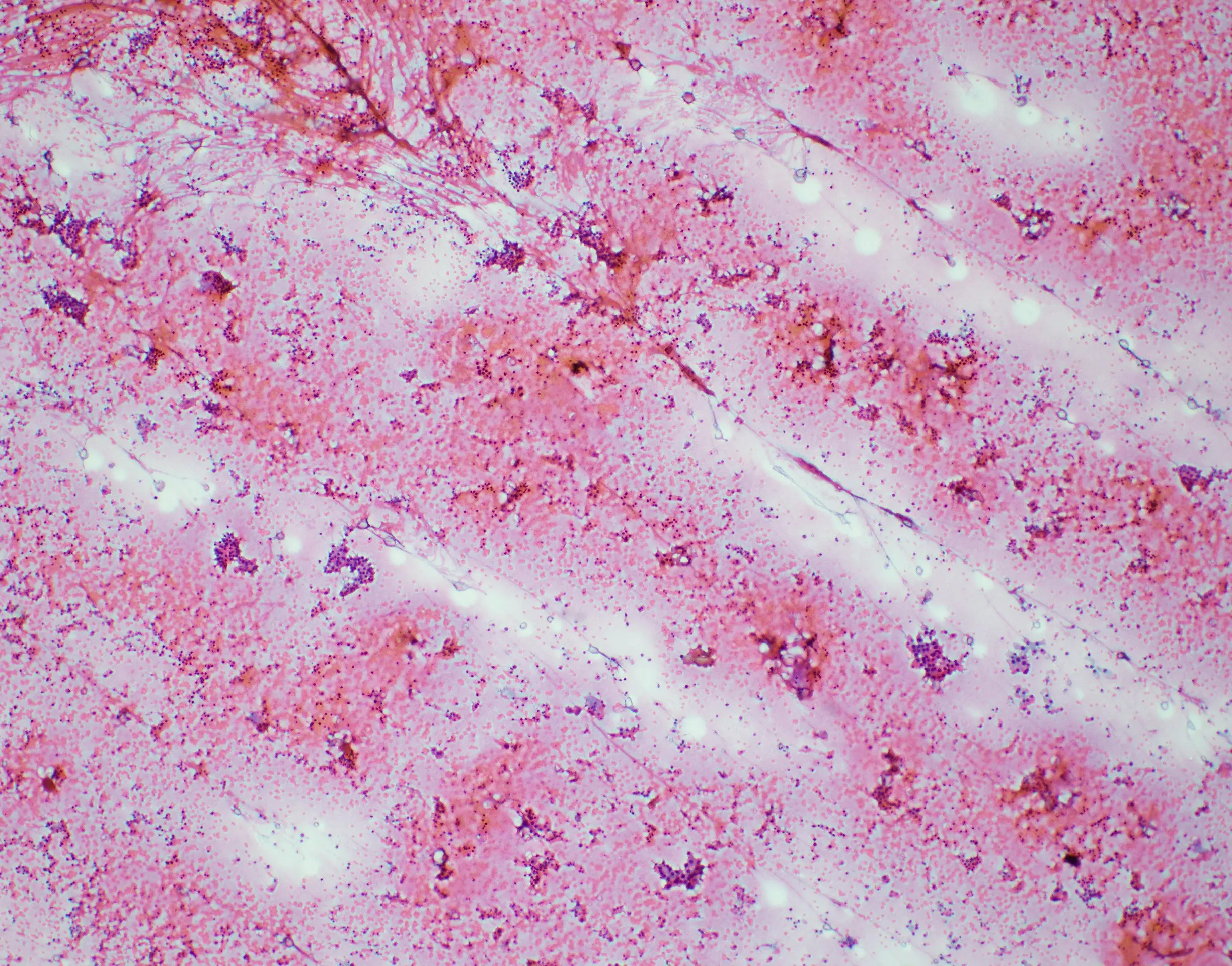 Benign Colloid nodule