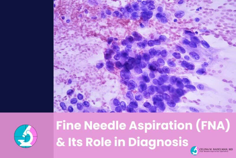 Fine needle aspiration