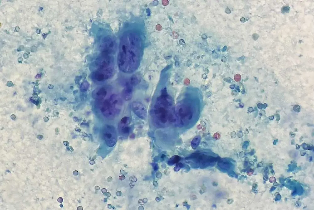 Fine Needle Aspiration Biopsy (FNA) | Dr. Celina Nadelman