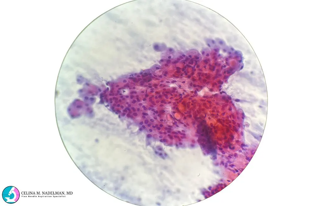 Microscopic view of a cell cluster stained in shades of purple and pink, used in an FNA biopsy. This image aids in accurate diagnosis, showcasing the precision and compassionate care provided by a cytopathologist.| Dr. Nadelman Biopsy Doctor