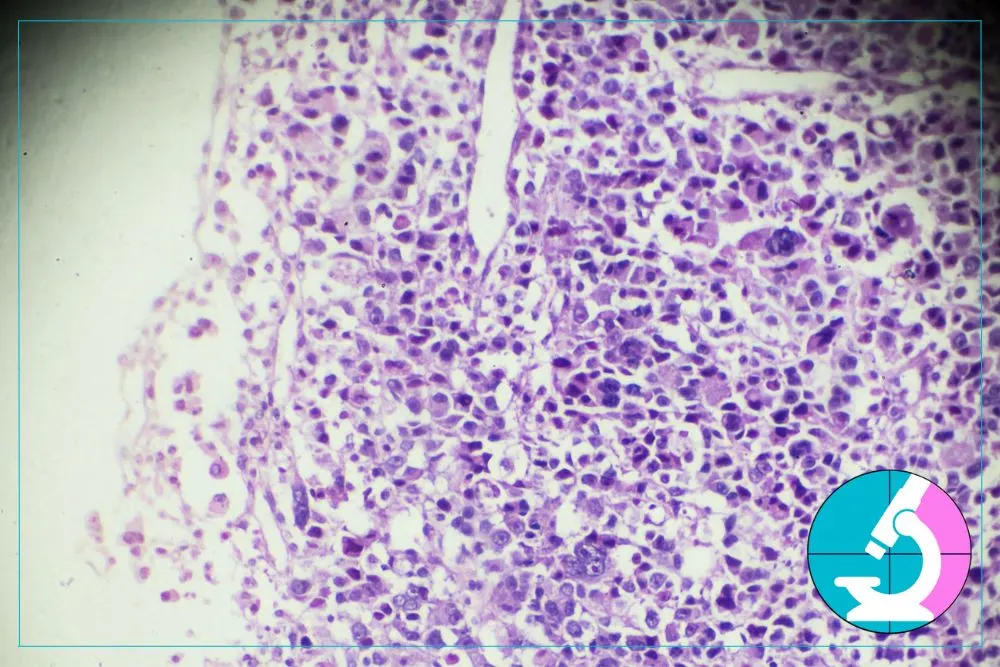 where to get a biopsy in los angeles