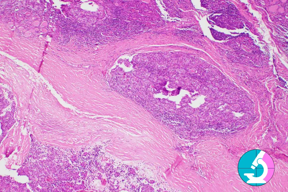 Hashimoto's Disease and Lymphoma Risk