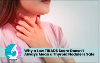 thyroid cancer despite low TIRADS score