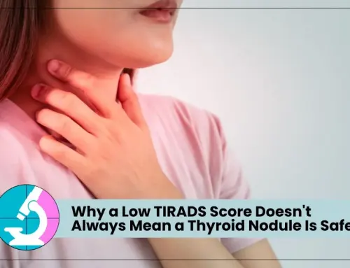 Why a Low TIRADS Score Doesn’t Always Mean a Thyroid Nodule Is Safe