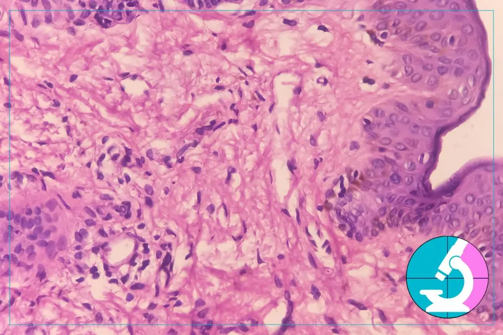 What Happens to Your Sample After a Thyroid FNA
