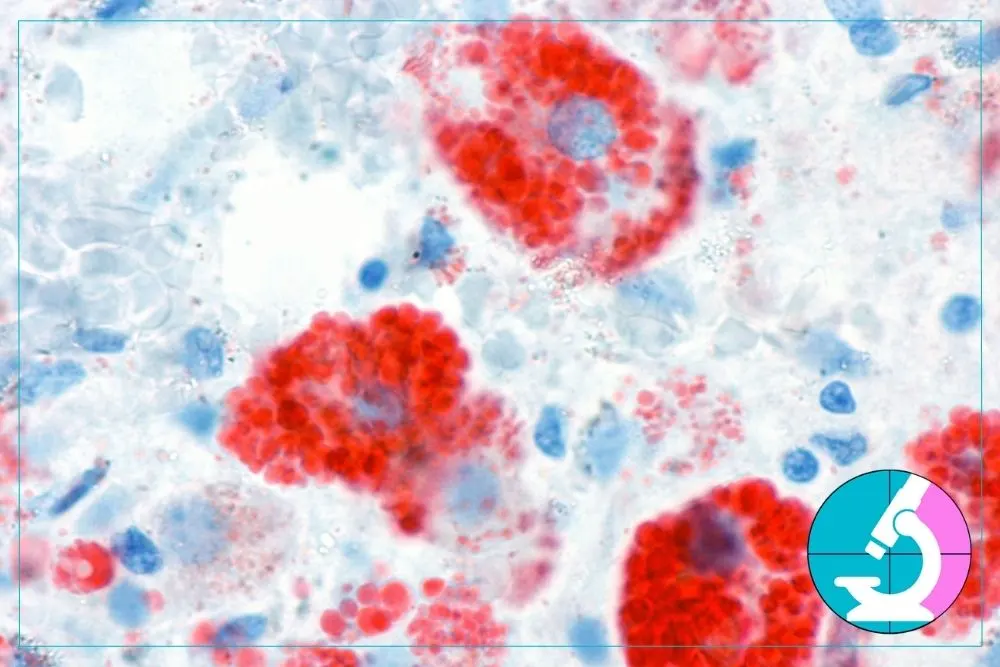 What Happens to Your Sample After a Thyroid FNA