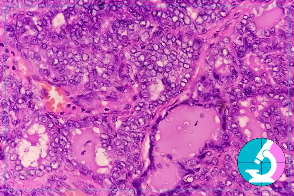 What_s the Difference Between Papillary vs. Follicular Thyroid Cancer (4) Papillary vs. Follicular Thyroid Cancer